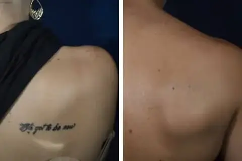 The Evolution of Laser Tattoo Removal Techniques: From Past to Present